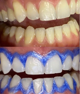 Rosto feminino de perfil recebendo aplicação de toxina botulínica