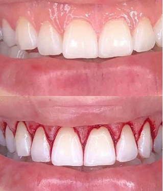 Rosto feminino de perfil recebendo aplicação de toxina botulínica